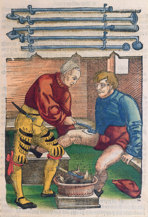 Cauterisation, illustration from 'Feldtbuch der Wundartzney' by Hans von Gersdorff, c.1540 (colour woodblock print)