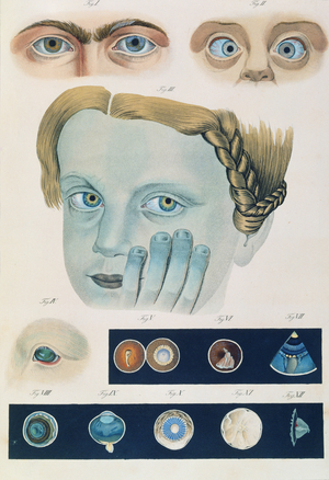 Description of congenital eye anomalies, from 'Klinische Darstellungen der Krankheiten und Blidungsfehler des Menschlichen Auges', by Friedrich August von Ammon (1799-1861) 1838 (coloured engraving)