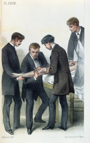 Amputating an arm, from a medical manual by Jean-Baptiste-Leon Dubreuil, c.1850-60 (colour litho)