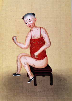 Child with smallpox (w/c on paper)