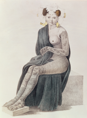 Congenital Ichthyosis, from a book by G.M. Olbers, 1830 (coloured engraving)