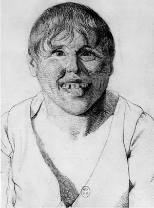 Cretine, -in “” Etude de la physionomie des alienes””, drawing by Gabriel, 1818