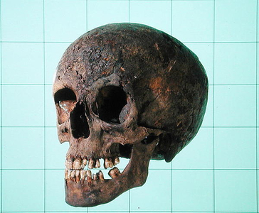 Female Syphilitic Skull (bone)