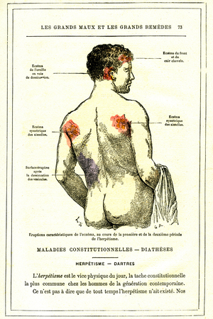 Constitutional disease - diatheses. Herpetism (herpes) dartres. Characteristically eruptions of eczema during the second period of herpetism. Engraving from “” Les Grands Ales et les Grands Remedes”” by Jules Rengade, 1889. From “The Principal Illnesses and Their Remedies” by Jules Rengade. (Paris, 1889).