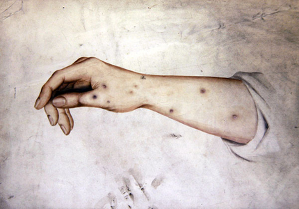 Study of a Forearm with skin condition, c.1850 (w/c on paper)