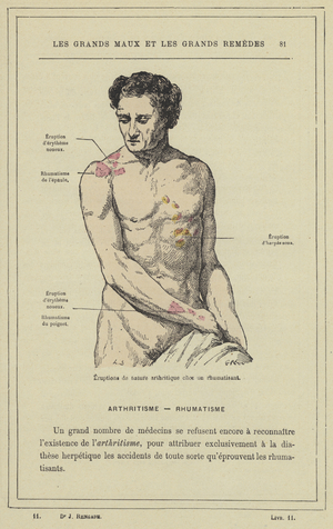 Eruptions de nature arthritique chez un rhumatisant (colour litho)