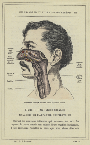 Inflammation chronique de fosses nasales, Coryza ulcereux (colour litho)