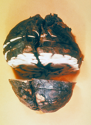 A cut brain showing haemorrhagic meningitis