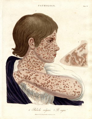 Rubeola vulgaris and Rubeola nigra - Pathological Illustration, 1810 (print)