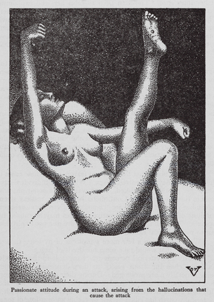 Woman experiencing an attack of hysteria (litho)