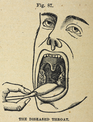 'The diseased throat'. An illustration showing a throat examination