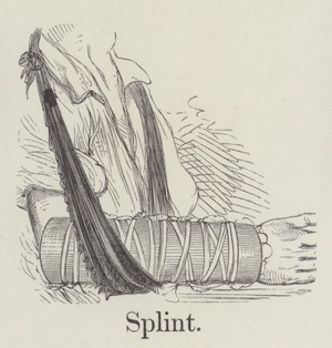 Splint (engraving)