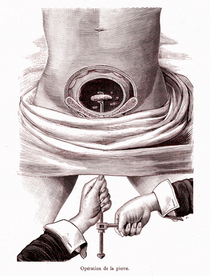 Surgery of renal lithiasis, 1888 (engraving)