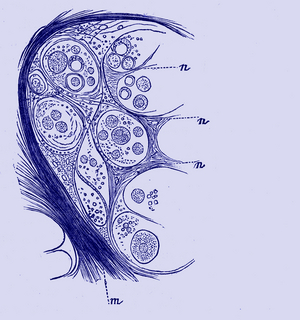 Colloid cancer cells ( Breast ), 1867 (engraving)