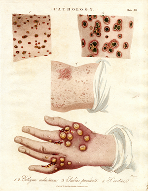 Skin Diseases: Ecthyma;Purulent Scabies and Smallpox, 1810 (print)