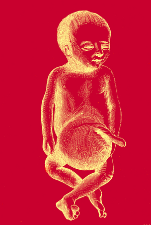Male fetus at term. Umbilical hernia, 1877 (engraving)