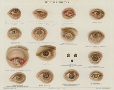 Eye disorders (colour litho)