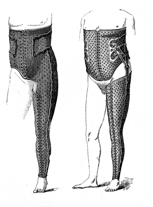 Tuberculosis of the hip, 1907 (engraving)