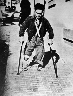 Amputee war veteran