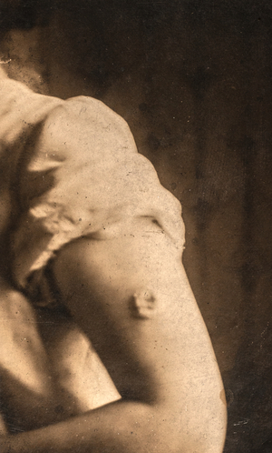 Vaccine Reaction, c.1920 (silver gelatin print)