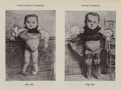 Club-foot before treatment; During treatment (b/w photo)