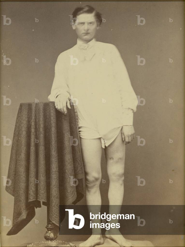 Injured Civil War Soldier (Private Charles Westerfield, Army Medical Museum Specimen No. 4278), April 1865, 1865 (albumen print)