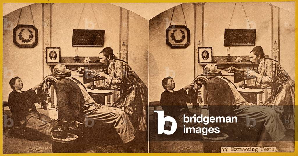 Dentist, Extracting Teeth, c.1875 (stereoview)