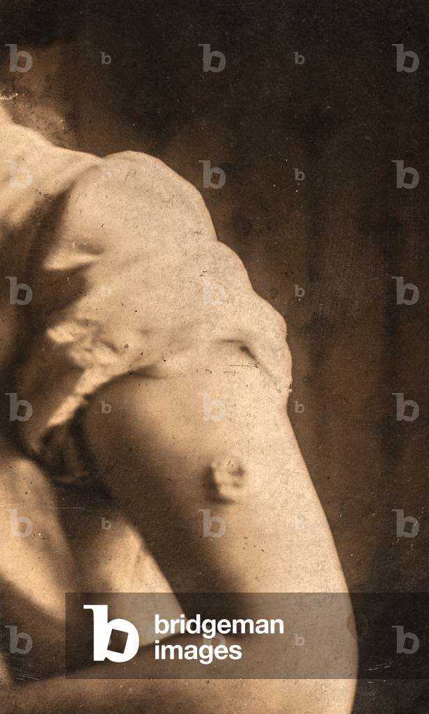 Vaccine Reaction, c.1920 (silver gelatin print)