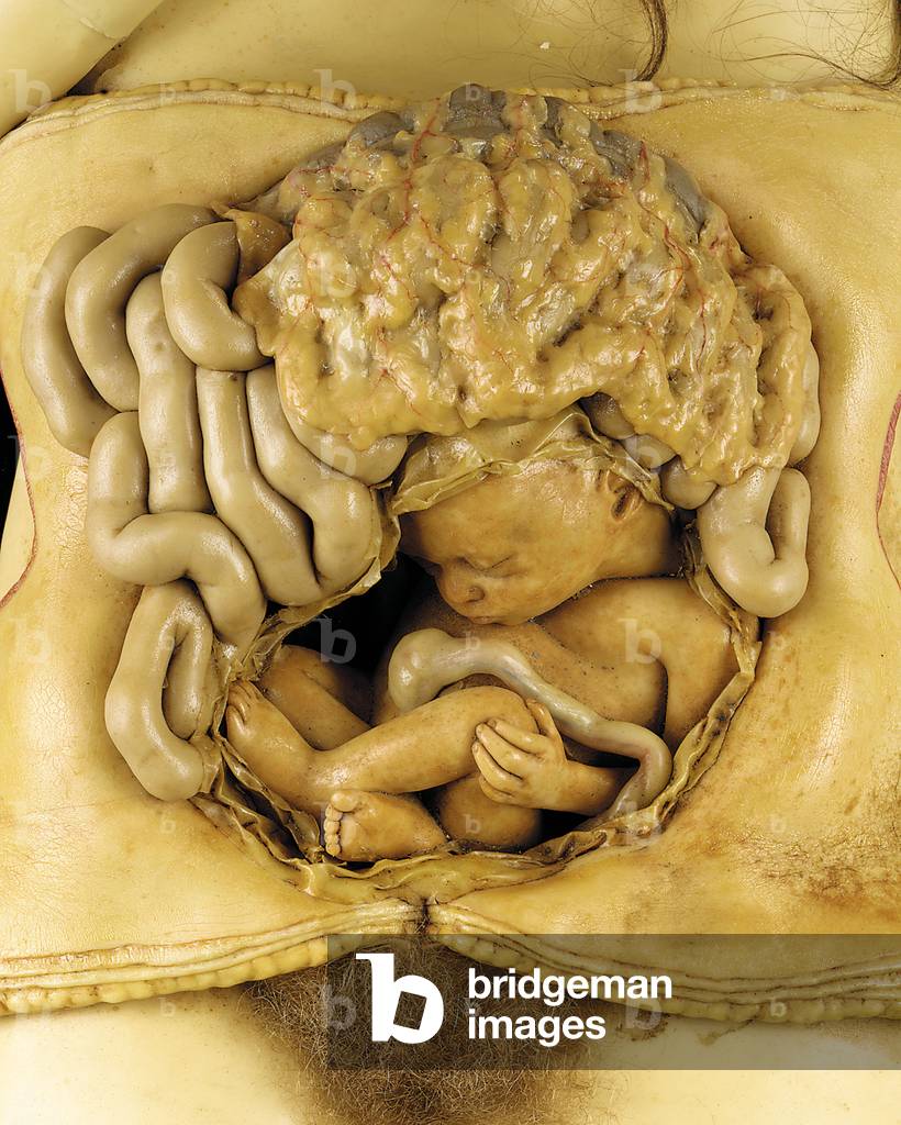 Anatomical model of an ovarian pregnancy, detail (wax) (see also 1126545-7)