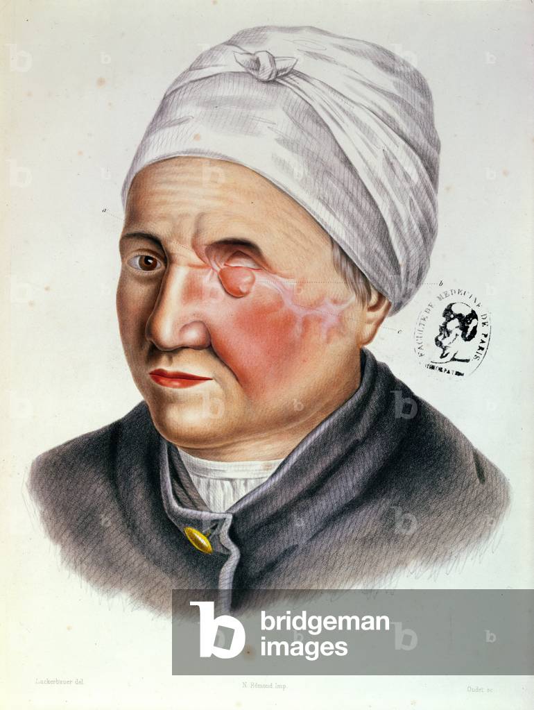 Illustration from 'Traite de Chirurgie Plastique' by Antoine Jobert de Lamballe (1799-1867) Paris, 1849 (coloured engraving)