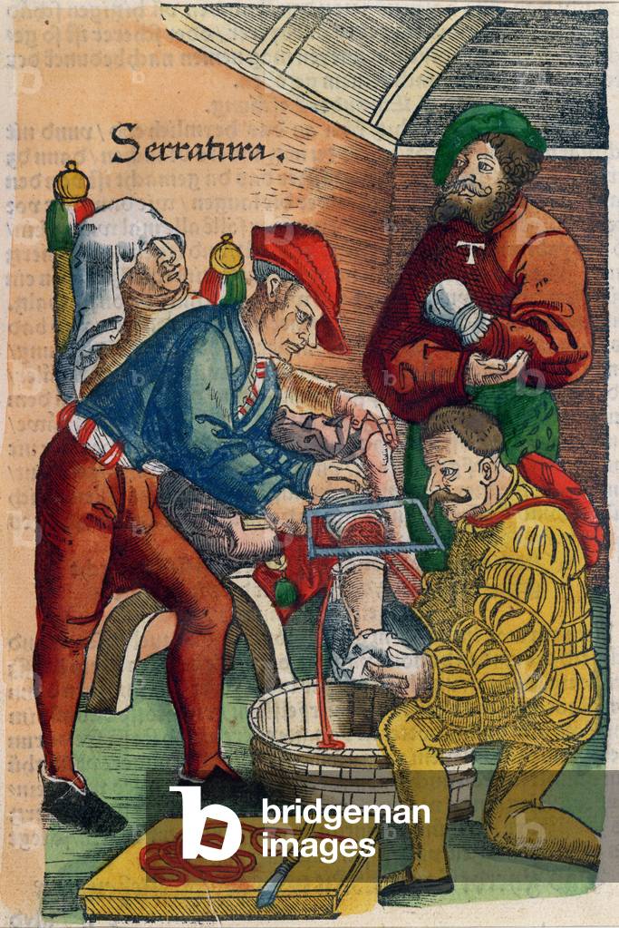 "Eine Amputation", 16. Jahrhundert von Hans or Johannes Ulrich Wechtlin