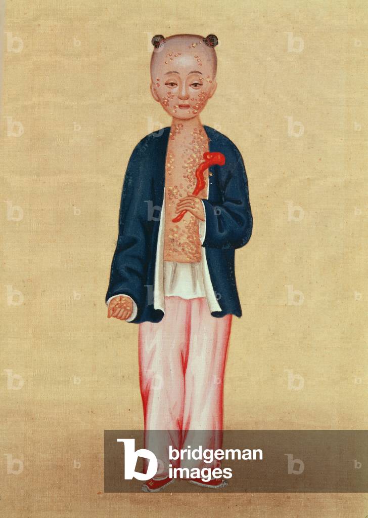 Child with smallpox (w/c on paper)