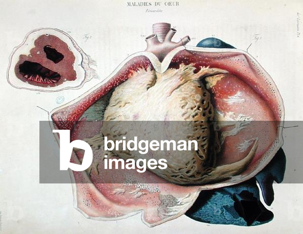 Pericarditis, plate depicting heart diseases from 'Anatomie pathologique du corps humain' by Jean Cruveilhier (1791-1874), published in Paris, 1828-42 (colour engraving)