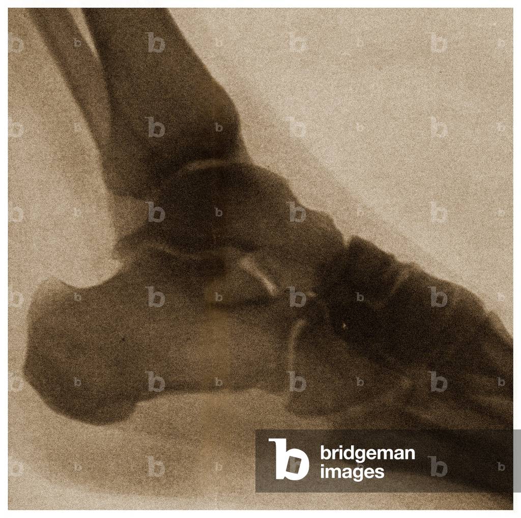 X Ray of an ankle c.1890 