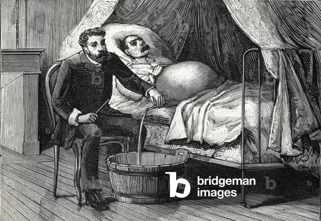 Patient with advanced liver cirrhosis, doctor performing a puncture (engraving) 1888