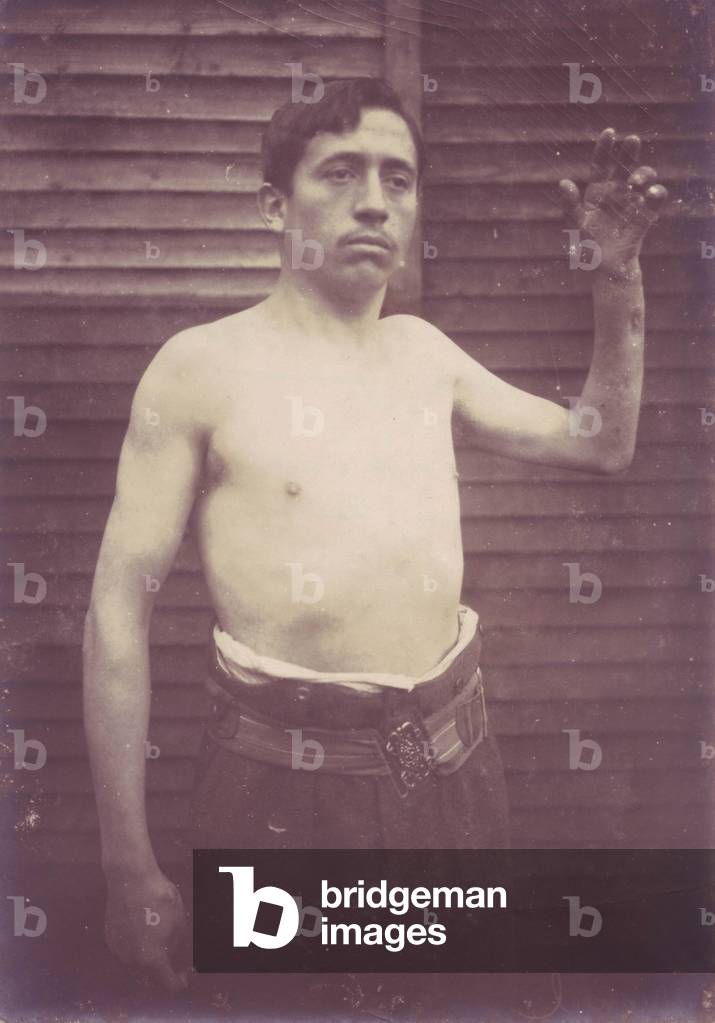 Soldat ayant ete blesse par eclats de grenade en 1915, apres son operation