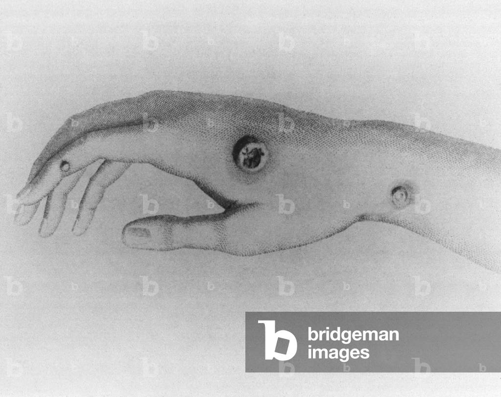 Cowpox pustule on the arm of milkmaid, Sarah Nelme, which Edward Jenner used as a source for his smallpox vaccine