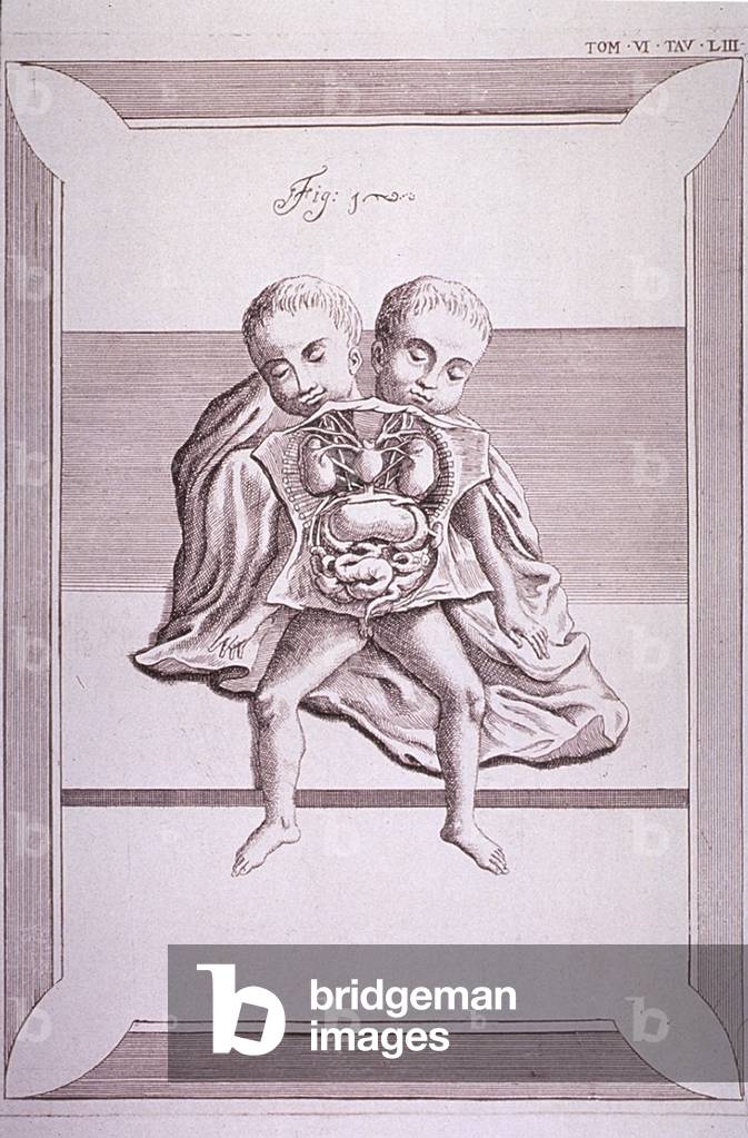 Conjoined twins with common torso and limbs, and the two heads. The abdomen and chest cavities are dissected open to show the organs. 18th century Italian engraving
