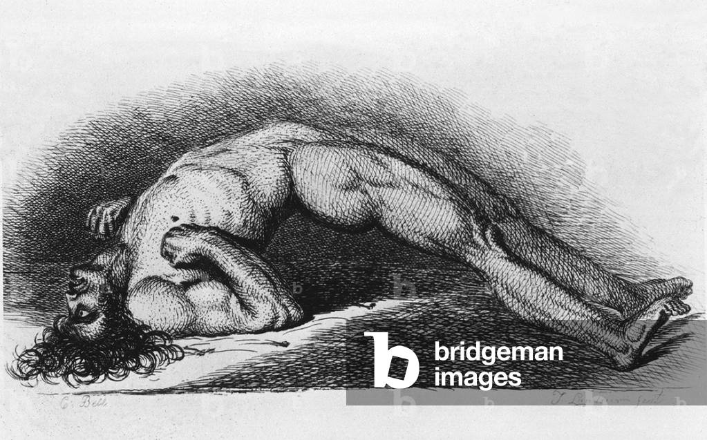 Tetanus (Lockjaw) victim. The contracted body of soldier suffering from tetanus. Engraving from painting by Charles Bell, 1809