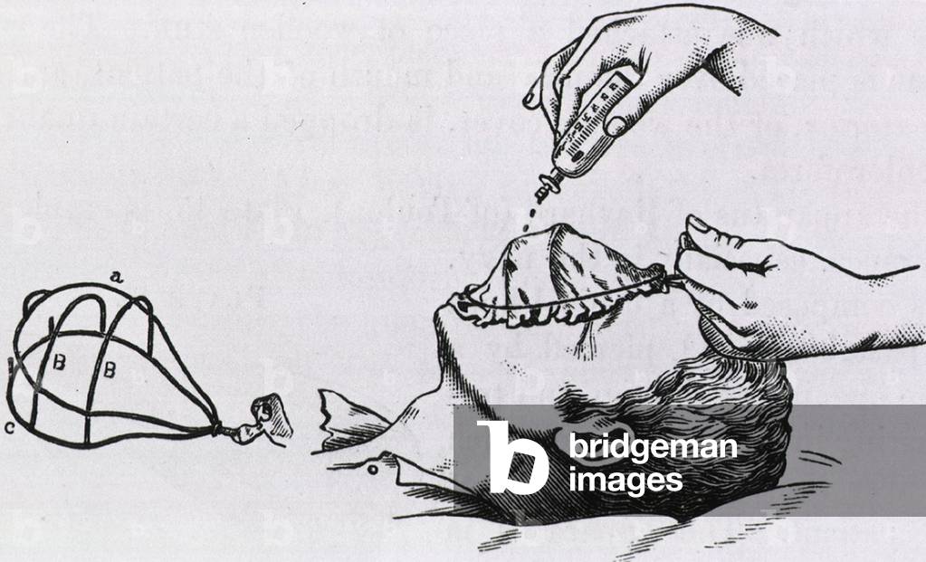 Wire frame supports a muslin cloth cover placed over the patient's face while drops of chloroform are dripped on the cloth. The wire frame without cover is shown on the left. From a 1896 text on anesthesia by Laurence Turnbull