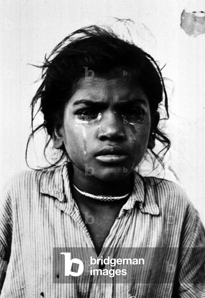 Trachoma. A young Indian girl with a Trachoma infection weeps continuously. WHO photo by Homer Page.: Trachoma. A young Indian girl with a Trachoma infection weeps continuously. WHO photo by Homer Page. ND