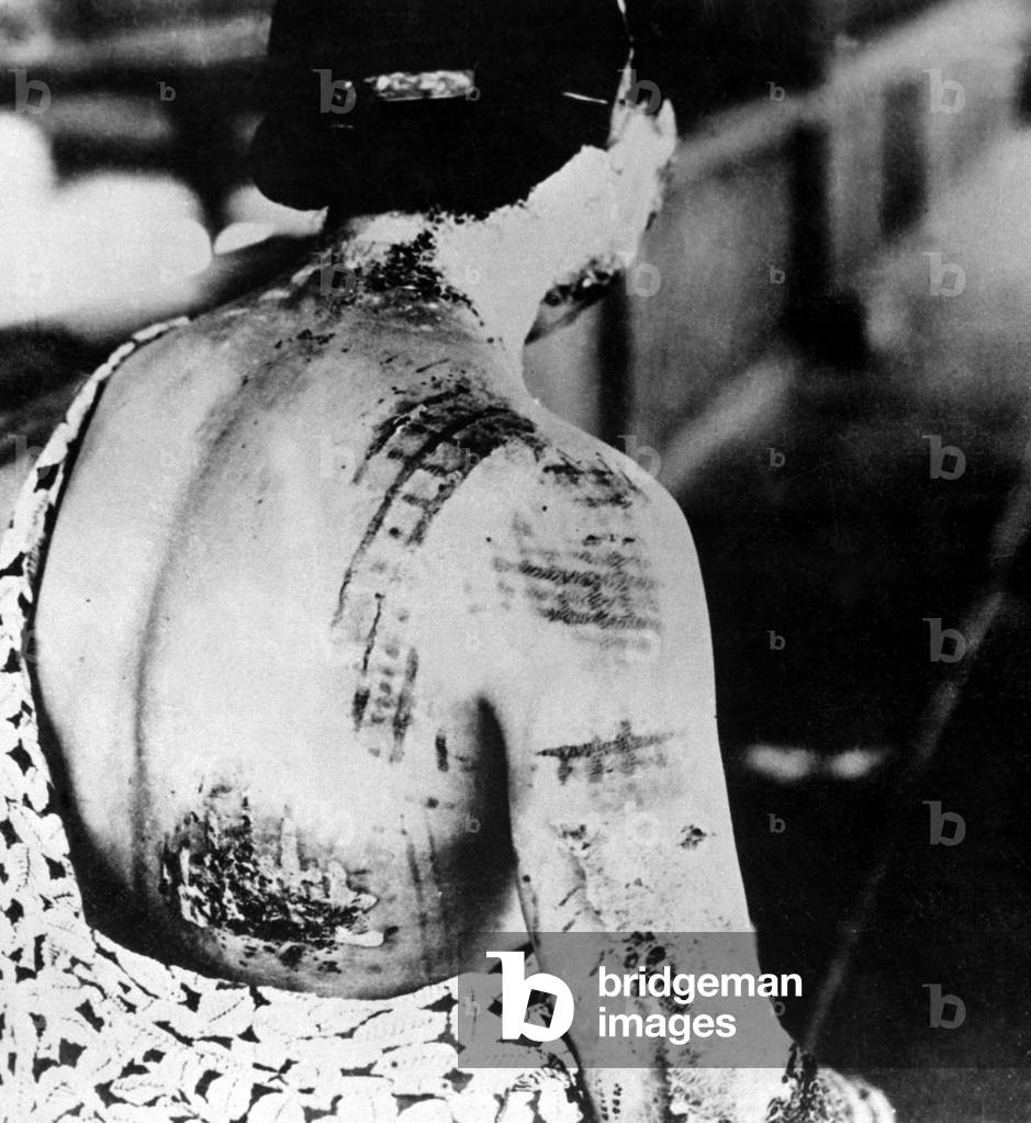 Injured female survivor's of Nagasaki, Japan, atomic bombing. Her skin is burned in a pattern corresponding to the dark portions of a kimono worn at the time of the explosion. Sept. 1945