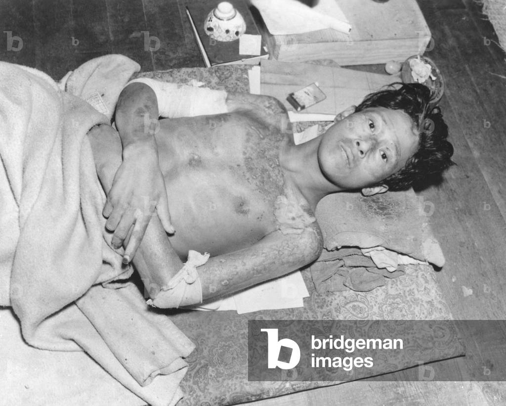 Japanese male victim of the atom bomb explosion over Nagasaki, Japan. Sept.-Dec. 1945