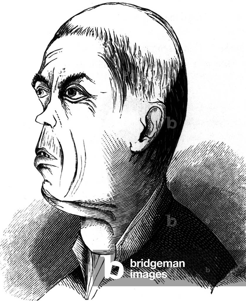 Types des ""délinquants"" : un voleur milanais, extrait de l'ouvrage ""L'homme délinquant"" de 1879 de Cesare 