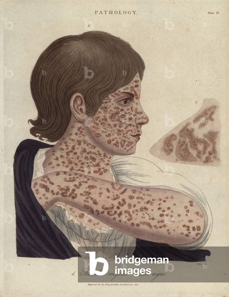 Measles
