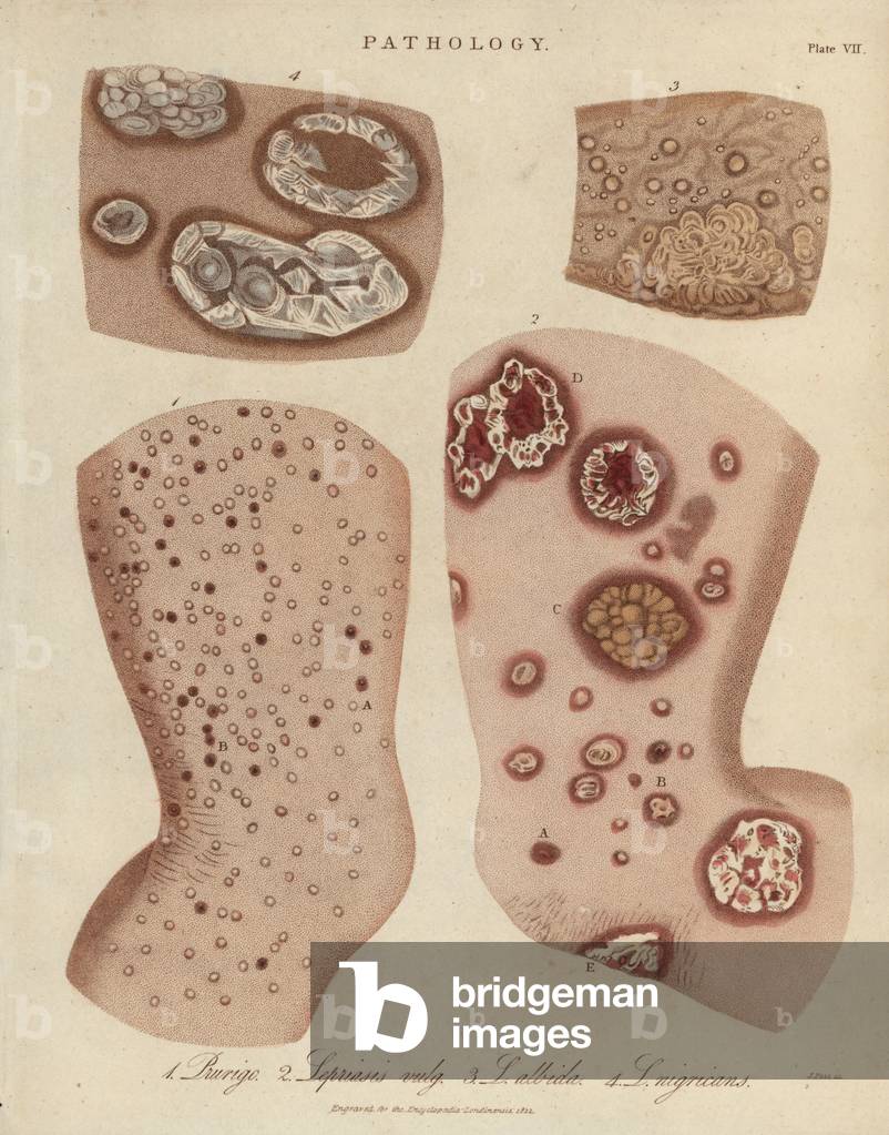 Psoriasis