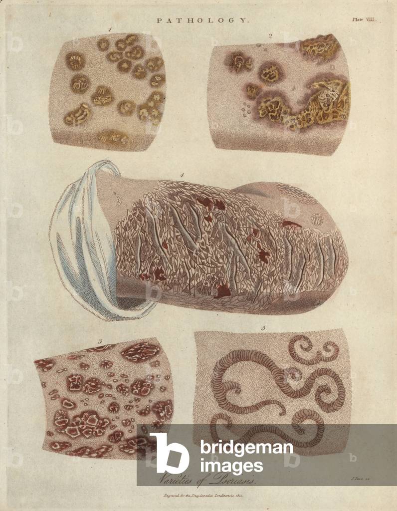 Varietes of skin disease autoimmune psoriasis - Lithography by John Pass, published in “Encyclopedia Londinensis” by John Wilkes, edition J.Adlard, London, 1822