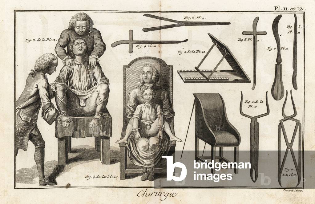 surgical chair with patient to remove a vesical calculation through the groin - Plate taken from “” L'Encyclopedie”” by Denis Diderot (1713-1784) and Jean Le Rond D'Alembert (1717-1783), 1779 - Surgical chairs with patients held in place for a bladder stone operation through the groin, Plate 12. Surgical instruments including dilators 1-3, curette 6 and hook curette 7, Plate 11. Copperplate engraving by Robert Benard from Denis Diderot's Encyclopedia, Pellet, Geneva, 1779.