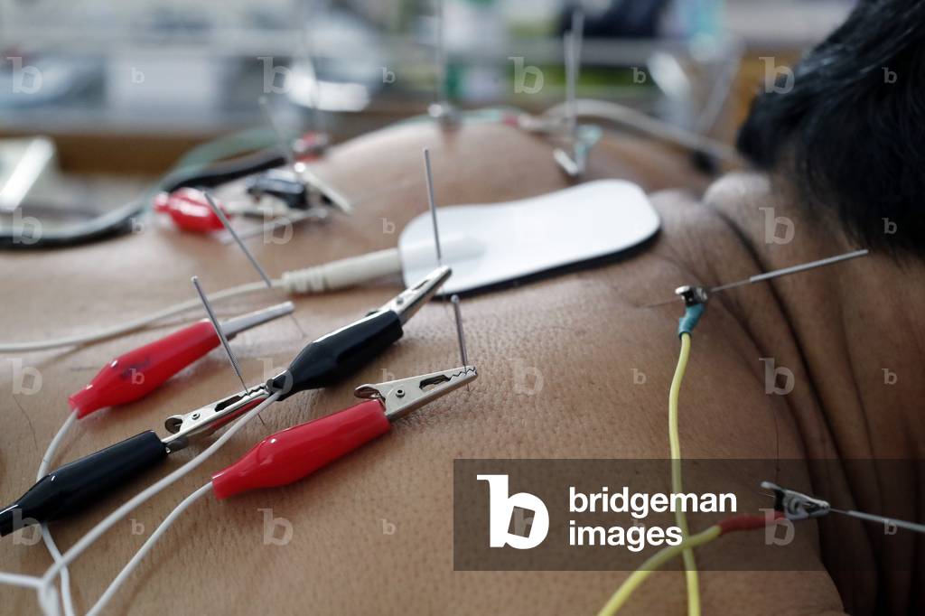 Vietnamese traditional medicine clinic, Acupuncture treatment, Cu Chi, Vietnam (photo)