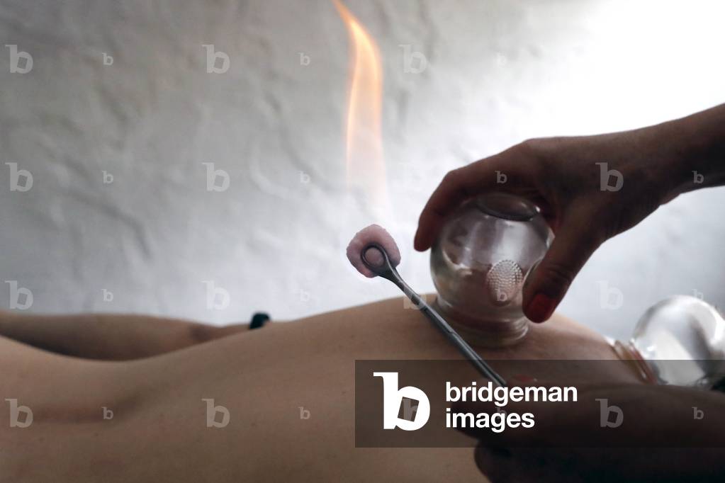 Traditional chinese medecine. Cupping therapy. Woman receving fire cupping.  France.